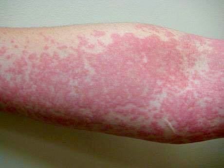 sun-hives-atopic-eczema