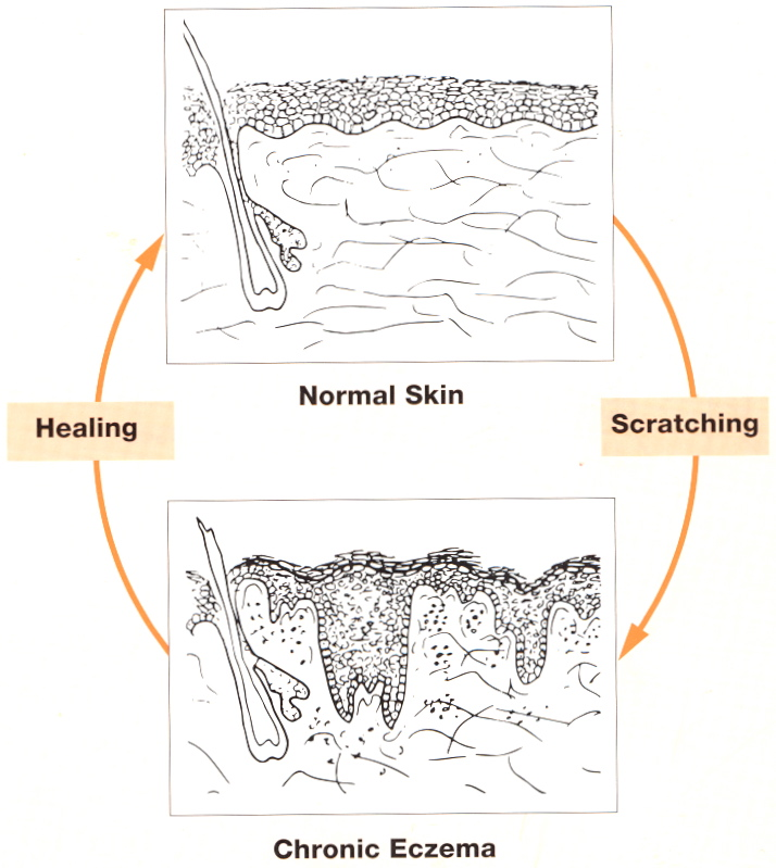“Behavioural dermatology – The Combined Approach to atopic eczema”